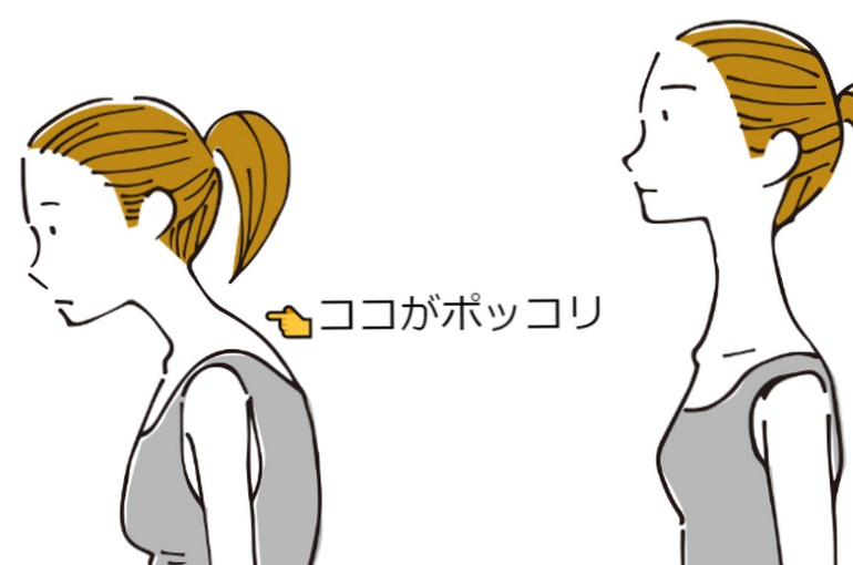 ぽっこり首. (2)